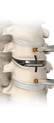 Cervical Artificial Disc Replacement