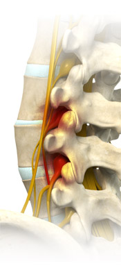 Spinal nerve Decompression